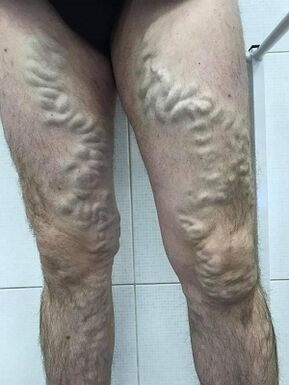παραμελημένοι ανδρικοί κιρσοί
