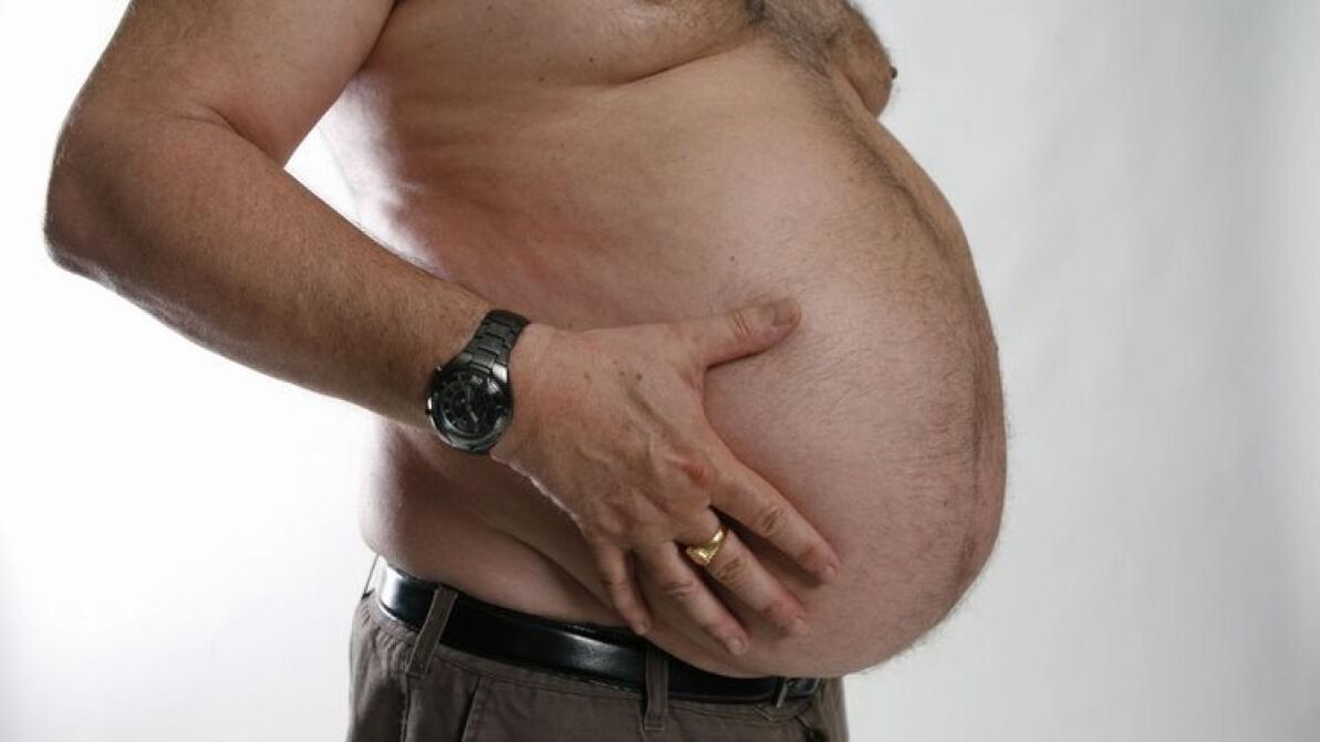 Η παχυσαρκία ως αιτία ανάπτυξης κιρσών