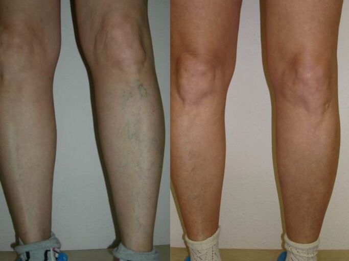 Πόδια πριν και μετά τη θεραπεία με λέιζερ κιρσών